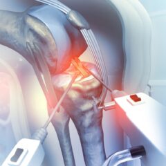 Tratamiento de la Artrosis: Desde Células Madre hasta Reemplazos Articulares